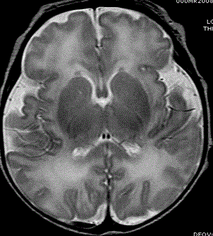 Image: Anatomy (MRI) full-term brain (Photo courtesy of RSNA).