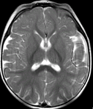 Photo:  Anatomy (MRI) of the brain—one year (Photo courtesy of RSNA).