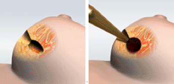 Image: Intrabeam IORT is delivered during the lumpectomy procedure, immediately following tumor removal (left). After the surgeon has removed the tumor, the radiation oncologist positions the Intrabeam applicator in the area of the breast where the tumor was located (right) (Photo courtesy of Zeiss).