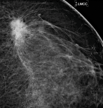 Image: Spot magnification view demonstrates an irregular spiculated mass with associated calcifications in the upper outer left breast. Ultrasound biopsy revealed invasive ductal carcinoma and DCIS (Photo courtesy of RSNA).