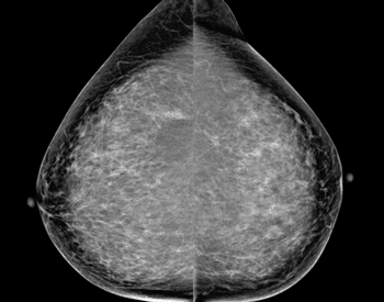 Image: Screening mammogram in a 63-year-old woman demonstrated calcifications in the upper outer left breast. Bilateral craniocaudal (CC) views shown (Photo courtesy of RSNA).