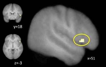 Image: Activity in the right inferior frontal gyrus (yellow, which shows portion of brain impacted by training) shifted from “during control” (reactive) to “before control” (proactive) (Photo courtesy of the University of Oregon). Image: Activity in the right inferior frontal gyrus (yellow, which shows portion of brain impacted by training) shifted from “during control” (reactive) to “before control” (proactive) (Photo courtesy of the University of Oregon).