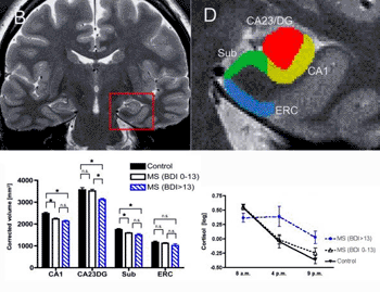 Image: MS Atrophy. Brain images showing location of hippocampus and its sub-regions in the brain. Bar graph shows atrophy within these specific hippocampal subregions. Black bars represent the control group; white bars represent people with MS who are not depressed; striped bars represent people with MS and depression (Photo courtesy of University of California - Los Angeles).
