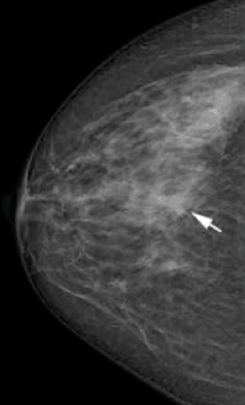 Image: Two-view screening mammograms obtained with the DR photon-counting system show a spiculated mass in the right upper quadrants (arrow). The diagnosis was invasive ductal carcinoma, 8 mm in diameter, as seen on the right craniocaudal image (Photo courtesy of Radiological Society of North America).