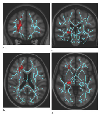 Convergence insufficiency correlates with increased FA in right anterior thalamic radiation, which is central to processing speed, and right geniculate nucleus optic radiations, the major relay station for the accommodation circuit central to oculomotor convergence. Asymmetric involvement of the right is not unexpected, as the corresponding left visual field is dominant for spatial processing as compared with the right visual field, which is dominant for nonspatial and/or temporal processing. Images derived from TBSS results and rendered on T1-weighted images from Montreal Neurologic Institute atlas show that significant white matter differences in patients with mild TBI and convergence insufficiency involve right anterior thalamic radiation, as shown in (a) coronal and (b) axial planes, and right geniculate nucleus optic radiations; as shown in (c) coronal and (d) axial planes. Significant voxels (P < .05, corrected for multiple comparisons) were thickened by using TBSS fill function into local tracts (red) and overlaid on white matter skeleton (blue) (Photo courtesy of Radiology).