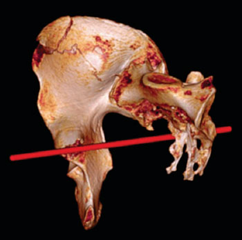 Image: Reconstructed right hemi-pelvis and sacrum post-mortem CT using Osirix. Red line shows estimated direction of sharp-force trauma (Photo courtesy of the Lancet).
