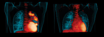 Image: “Hot spots” of infection in a patient’s lungs before treatment (left). Disease improvement after six months of taking the drug linezolid (right) (Photo courtesy of the University of Pittsburgh).