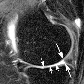 Image: Examples of meniscal tears and status after surgery. Sagittal intermediate-weighted fat-saturated image post-surgery shows substance loss of the posterior horn of the medial meniscus (large arrows) and concomitant cartilage (Photo courtesy of RSNA).