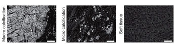 Image: Electron microscope images of plaque calcification stages (Image courtesy of University of Cambridge).