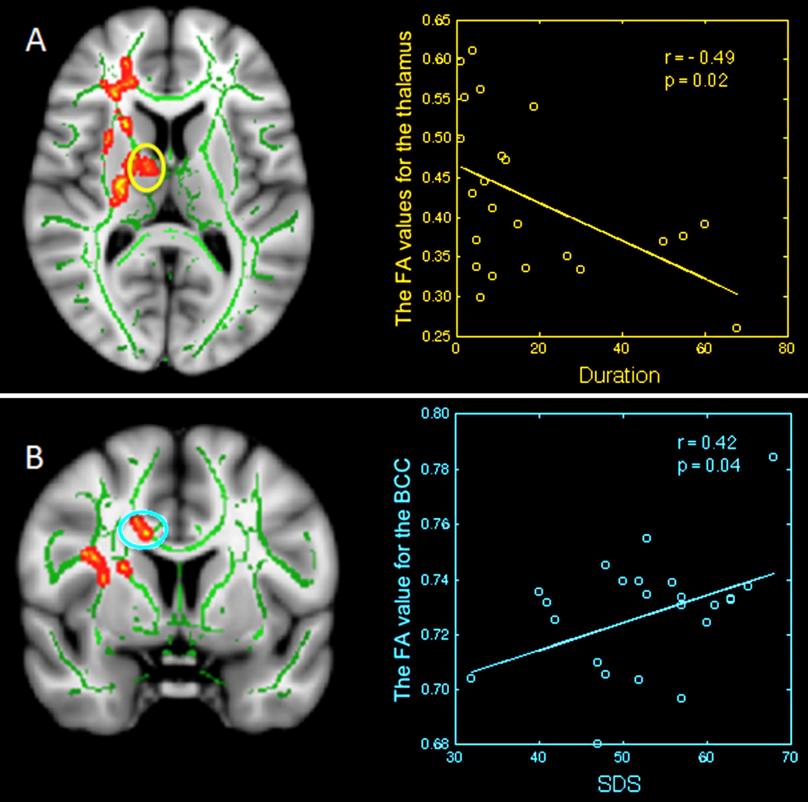 Image: Images on the left display region-of-interest maps of the relationship between mean FA and disease duration, and clinical features in primary insomnia, while the corresponding graphs are displayed on the right (Photo courtesy of RSNA).