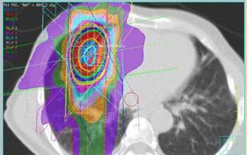 Image: An example of dose distribution of SBRT for lung cancer (Photo courtesy of the NIH).