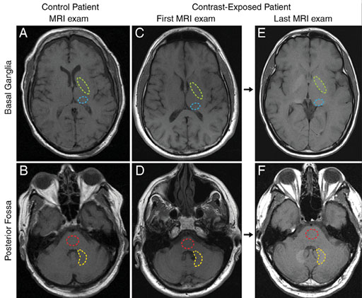 Image: A comparison of MRI exams carried out with and without gadolinium-based contrast agents (Photo courtesy of Radiology Journal).