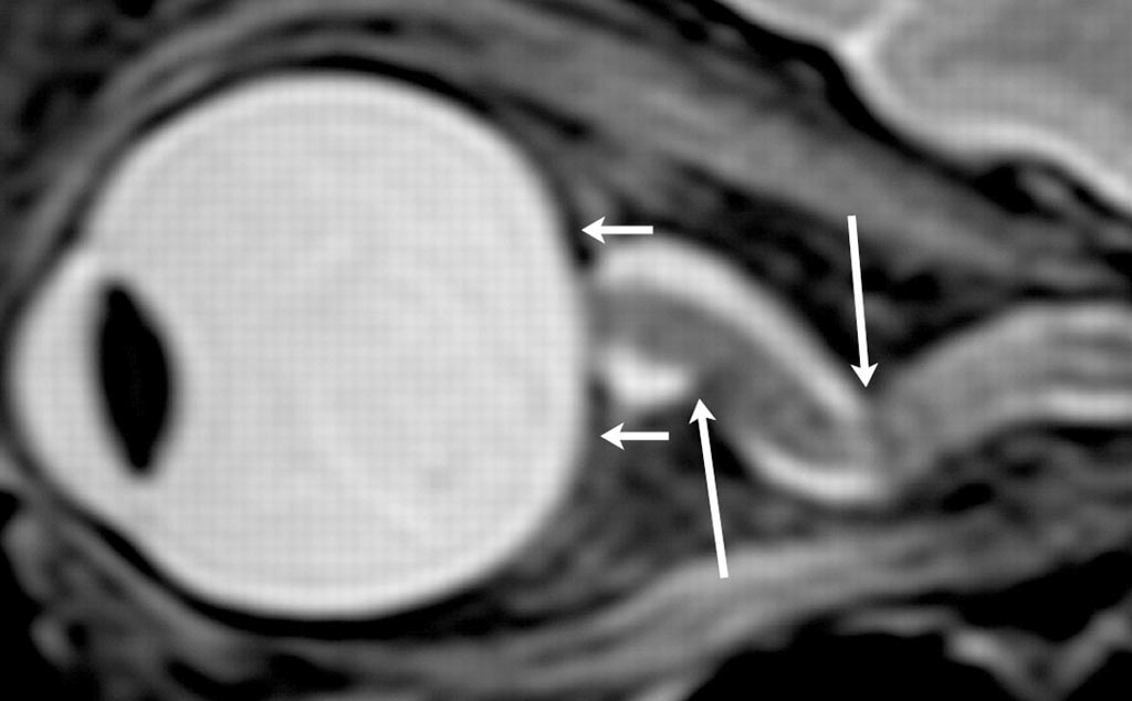 Image: An abruptly angulated foci in the optic nerve sheath, as well as globe flattening at the back of the eyeball, from a 2012 study of astronauts (Photo courtesy of RSNA).