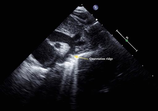 Image: An ultrasound image that shows narrowing of the aorta (Photo courtesy of Haki Jashari).