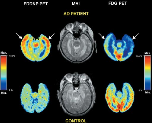 Image: An example of an FDG-PET imaging scan of the human brain (Photo courtesy of PubMed).