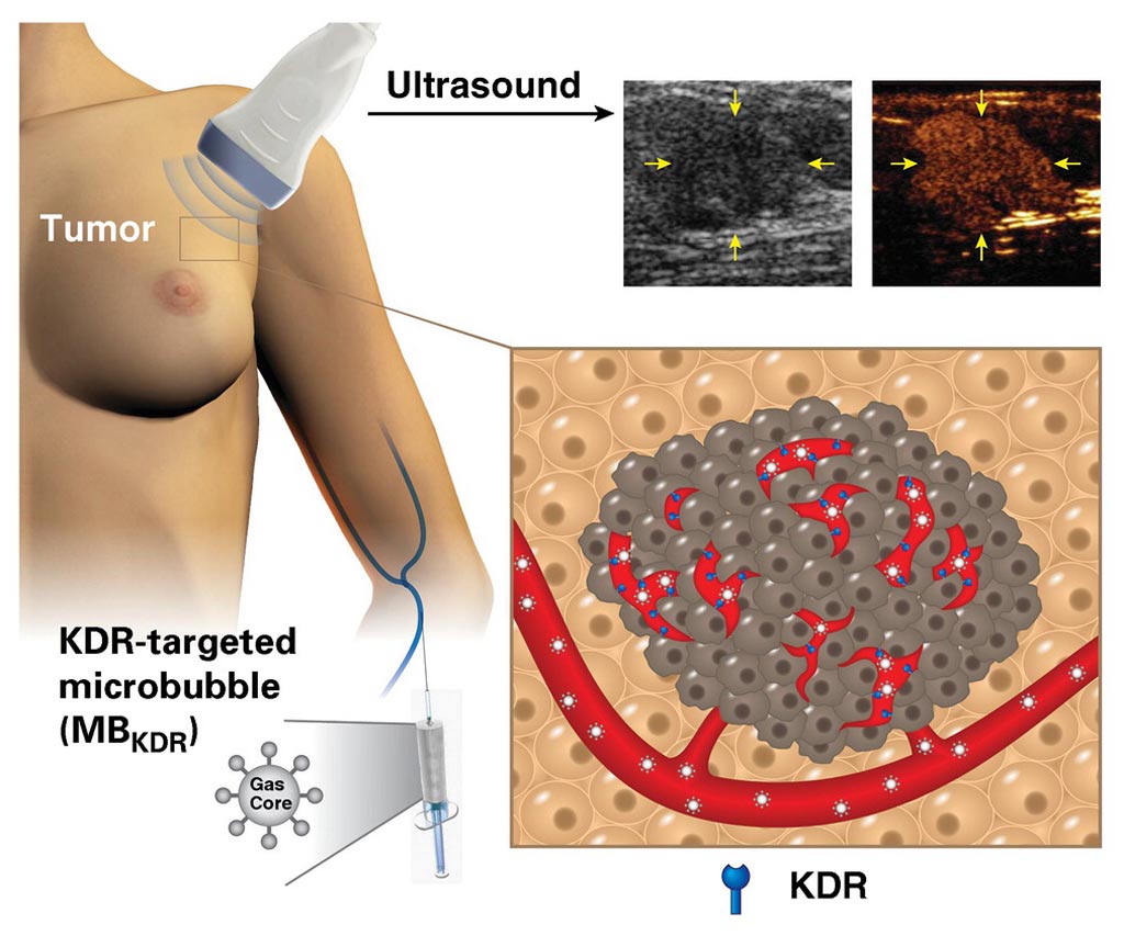 Image: New research suggests labeled microbubbles could help detect malignant cancer (Photo courtesy of Stanford University).