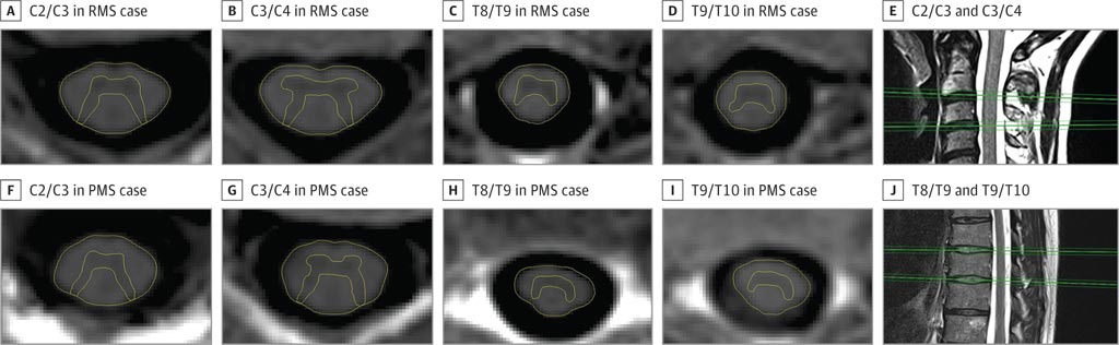 Image: Inversion recovery images illustrating gray matter atrophy in MS (Photo courtesy of Regina Schlaeger).