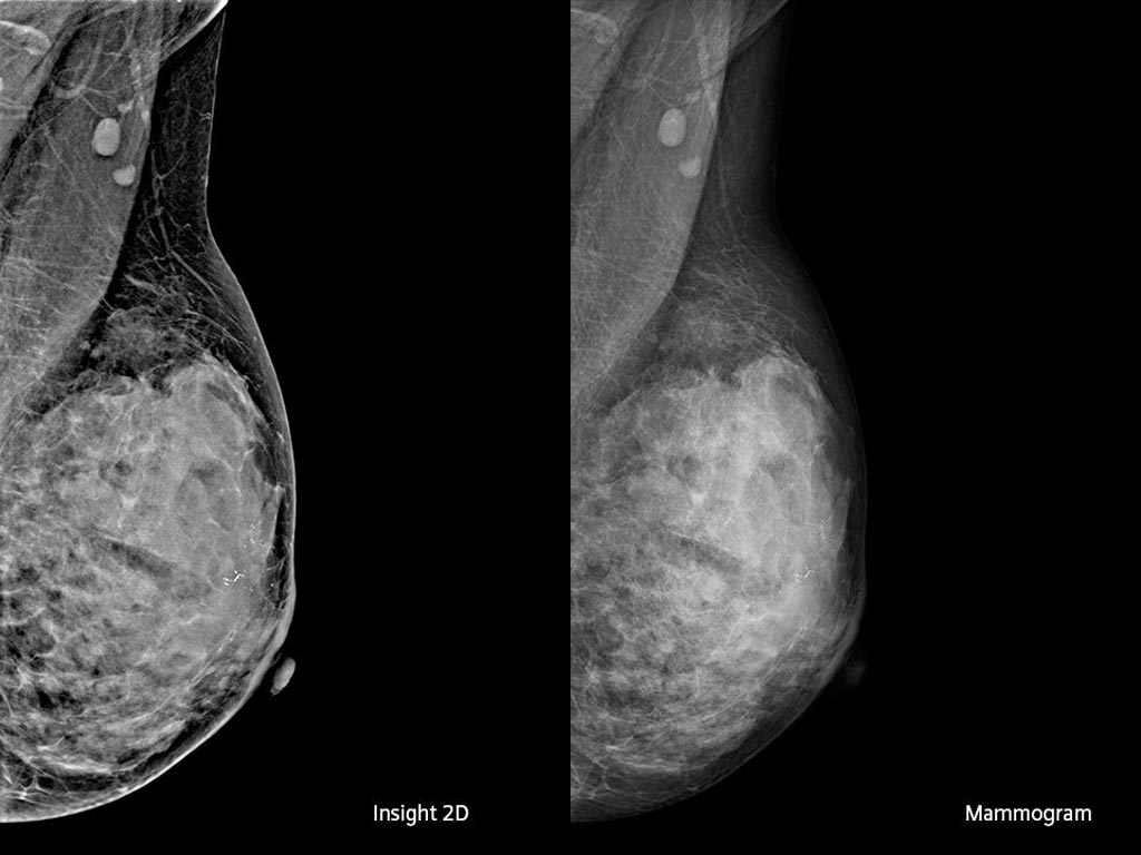 Image: An Insight 2D image generated from DBT compared to standard mammogram (Photo courtesy of Siemens Healthineers).