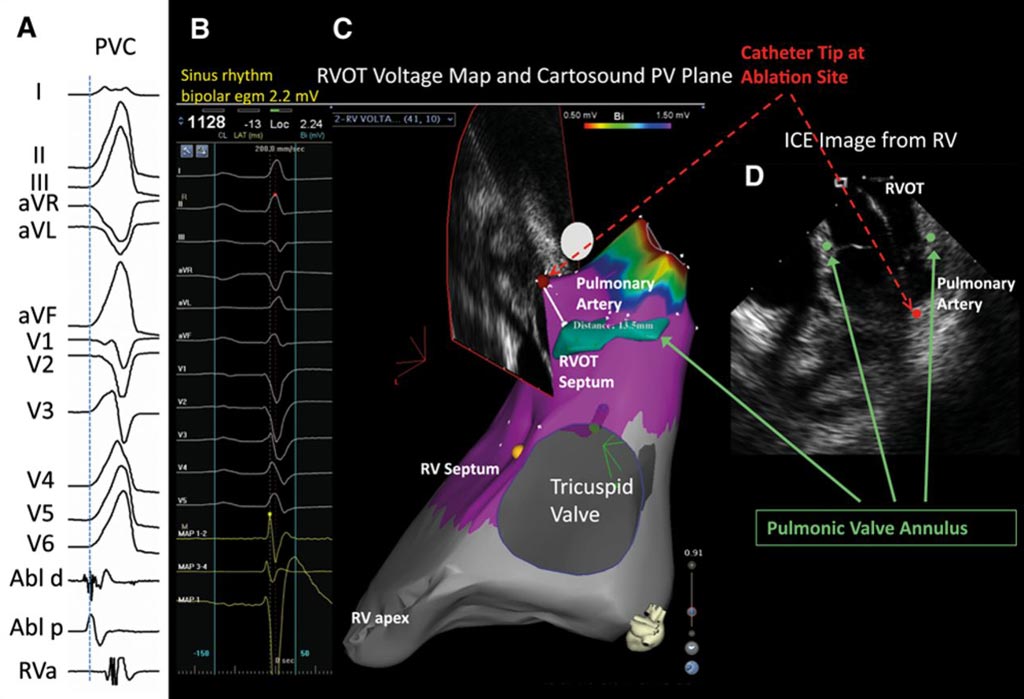 Image: An example of the use of Intracardiac EchoCardiography (ICE) to investigate atrial fibrillation (Photo courtesy of the AHA Journals).