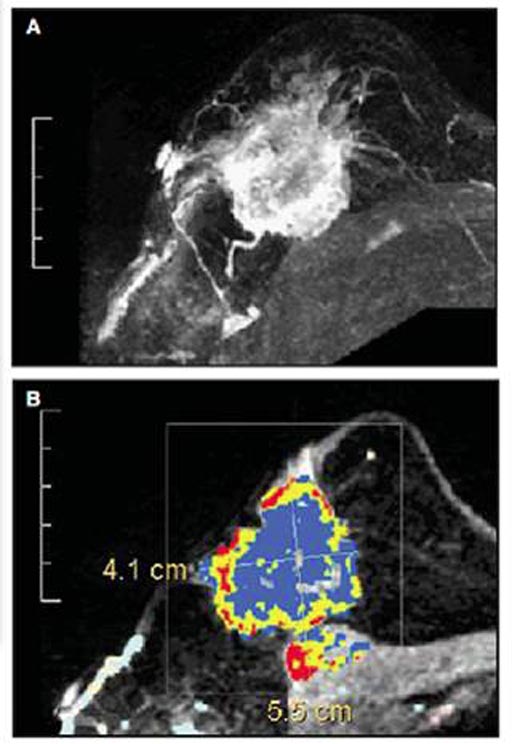 Image: Research shows MRI can detect breast cancer that is missed by mammography and ultrasound (Photo courtesy of the Seoul National University College of Medicine).