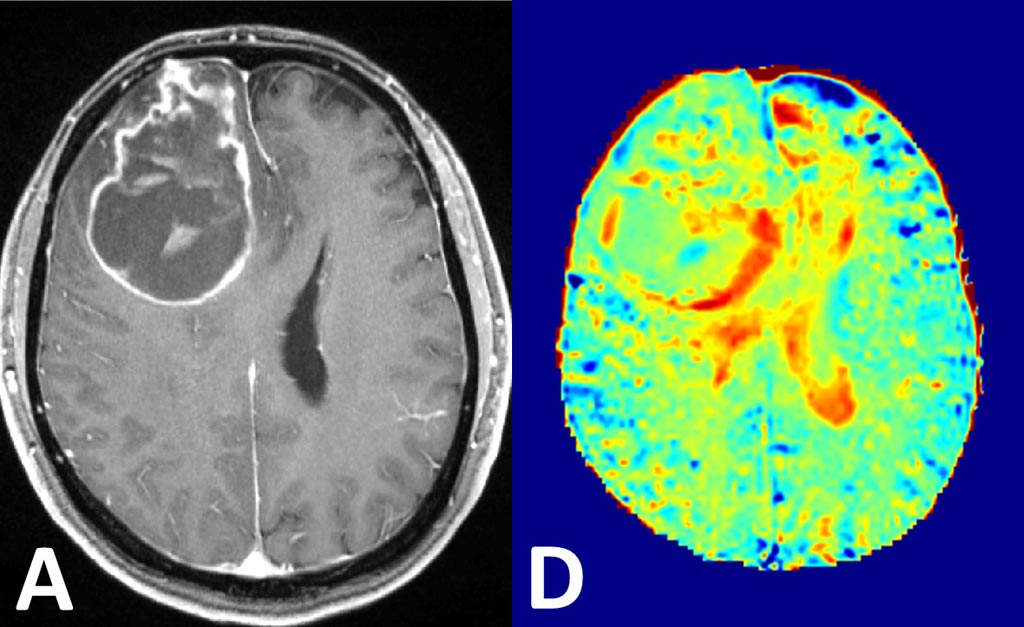 Image: Visualization of brain cancer by conventional contrast agents (L) and using glucose MRI method (R) (Photo courtesy of DKFZ).