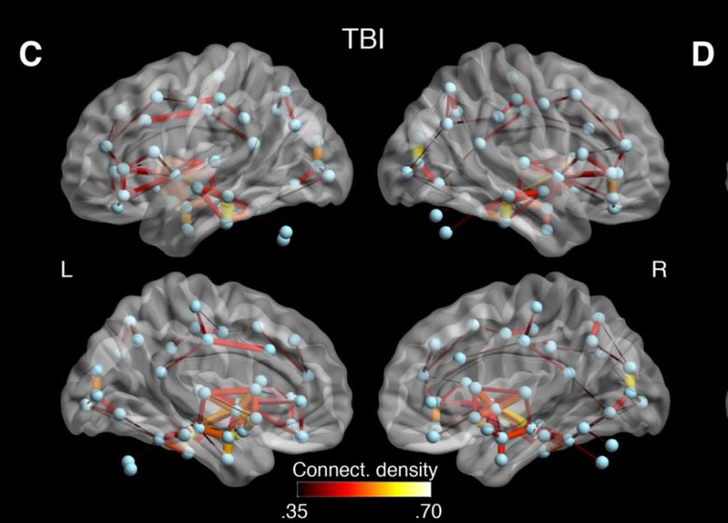 Image: Researchers found that white matter connections between several brain regions of concussed individuals showed abnormal connectivity that might reflect both degeneration and the brain\'s method of compensating for damage (Photo courtesy of Dr. Sebastien Tremblay).