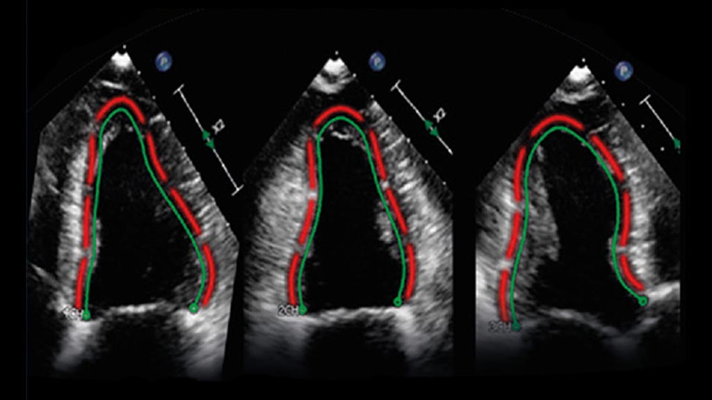 Image: Two sample images processed by the TOMTEC ultrasound image analysis software (Photo courtesy of Philips Healthcare).