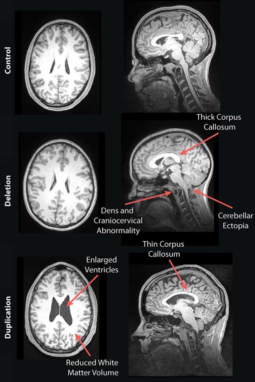 Image: The MRI images show examples of the brains of a deletion carrier, a duplication carrier, and a control participant in the study (Photo courtesy of RSNA).