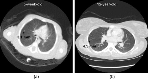 Image: The image shows the effect of reconstruction Field of View (FOV) size on the displayed diameter of a nodule in a five week old, and a 12-year-old child (Photo courtesy of Ehsan Samei, Donald Frush, and Xiang Li).