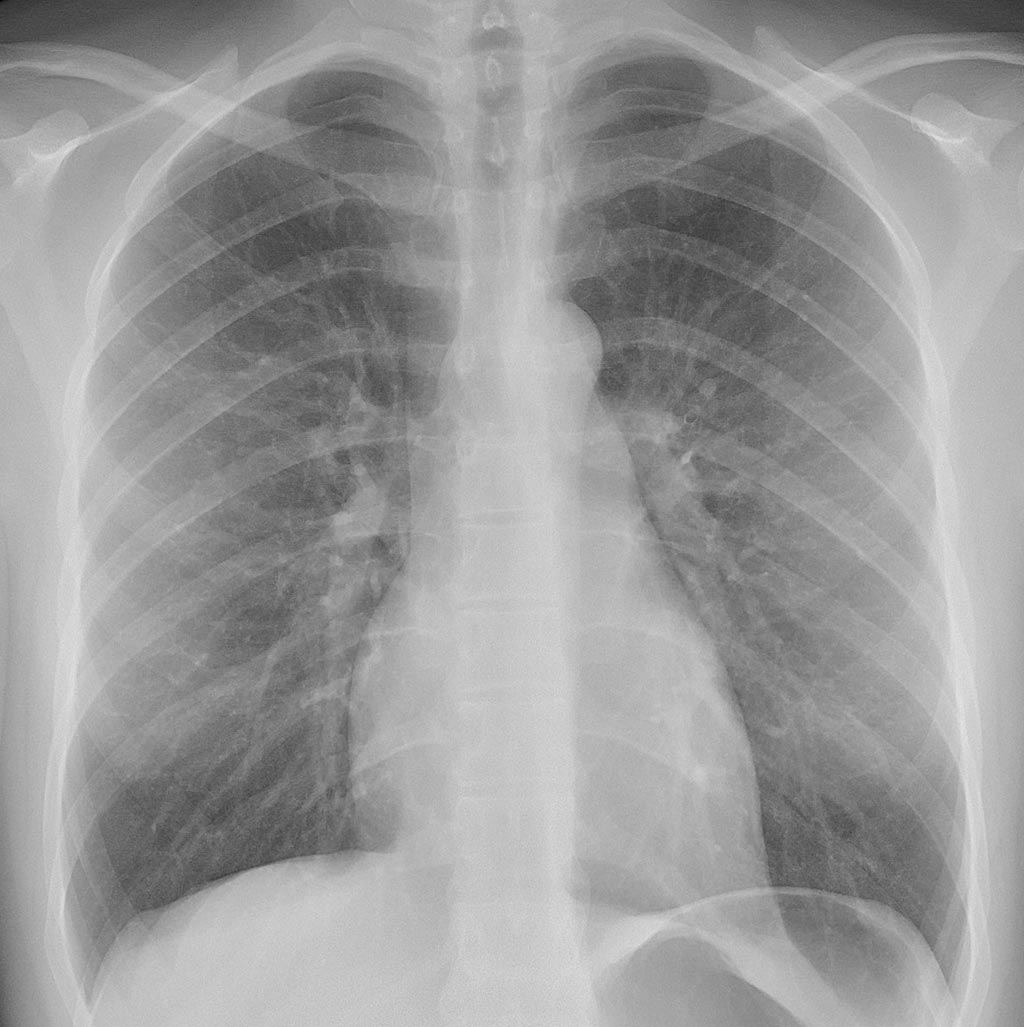 Image: A normal chest x-ray (Photo courtesy of Wikipedia).