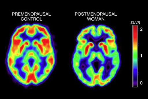 Image: The left-hand PET scan shows brain activity in a pre-menopausal woman, while the scan on the right shows brain activity in a post-menopausal woman (Photo courtesy of WCM).