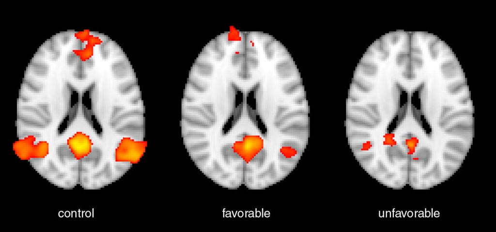 Image: The images show an fMRI scan of a healthy control subject on the left; a scan of a patient after a cardiac arrest with a good functional outcome in the middle; and a cardiac arrest patient with a poor functional outcome on the right (Photo courtesy of RSNA).