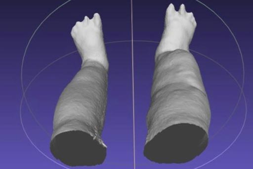 Image: A portable scanning device produces a 3-D reconstruction of swollen legs caused by lymphatic filariasis (Photo courtesy of Michael J. Weiler / LymphaTech).