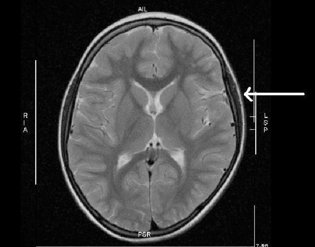 Image: A depression of the brain during birth due to large head circumference (Photo courtesy of Ruhr University).