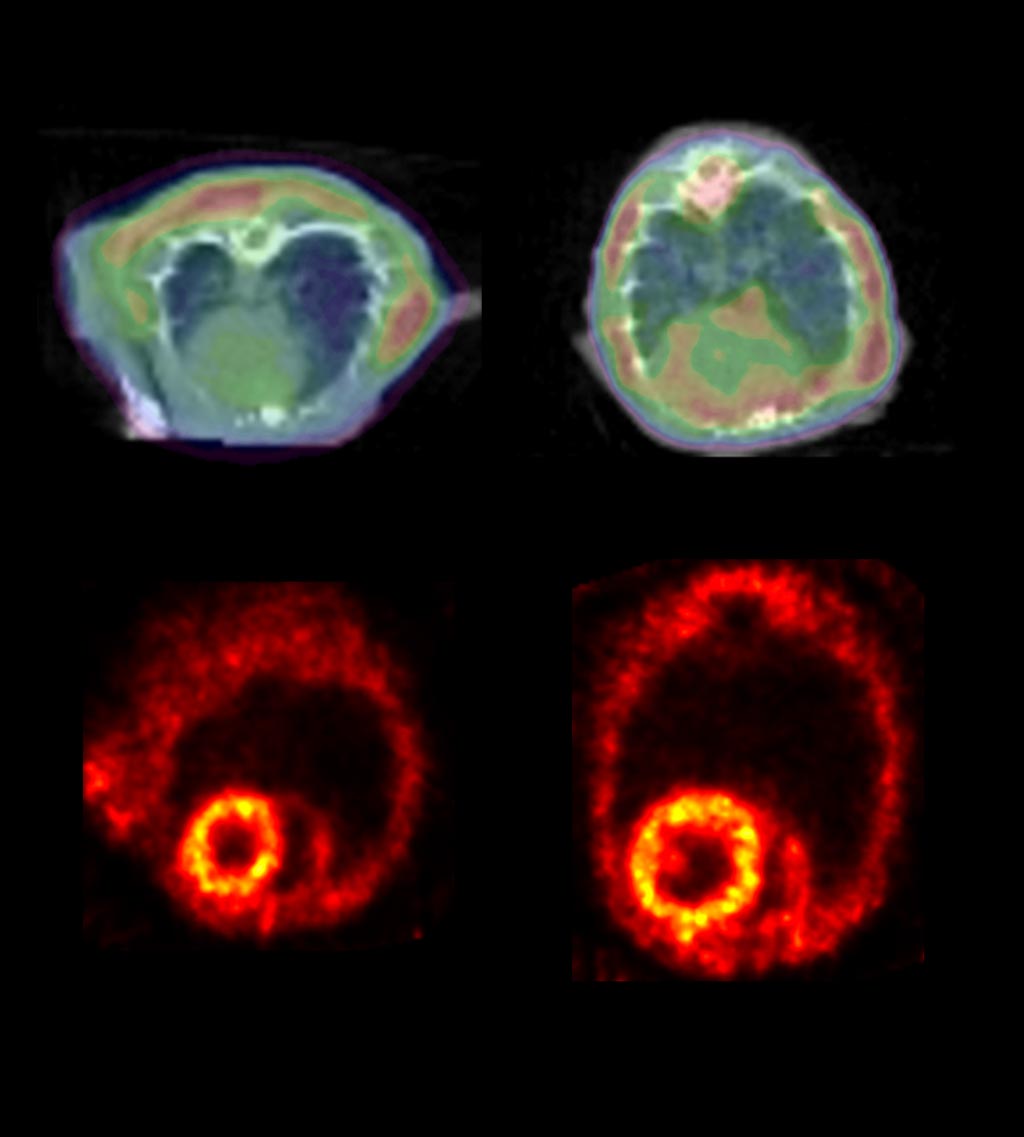 Image: A PET scan detects clumping proteins in HF (R) (Photo courtesy of Johns Hopkins University).