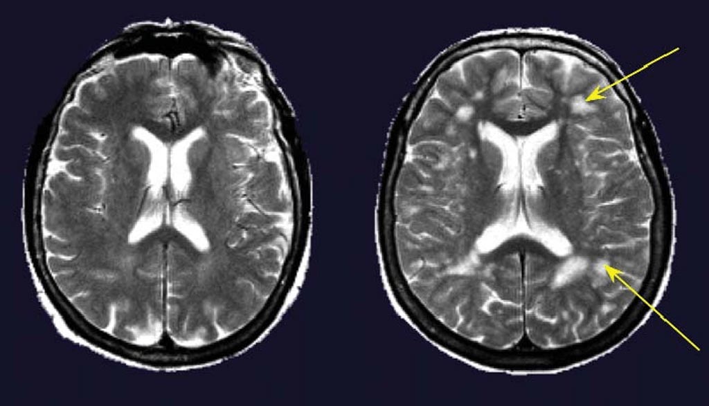 Image: Cerebral MRIs of two women 67 years of age without (left) and with (right) hypertension. The subject with hypertension had several deep and periventricular white matter lesions (arrows) (Photo courtesy of ResearchGate).