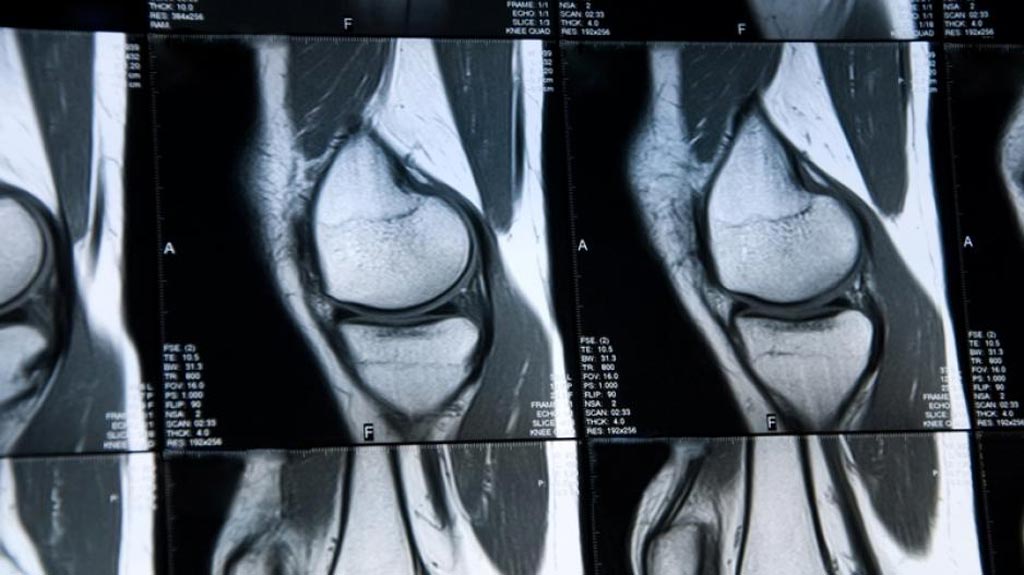 Image: Researchers have developed a deep learning–based system for cartilage lesion detection in knee MR images (Photo courtesy of Health Imaging).