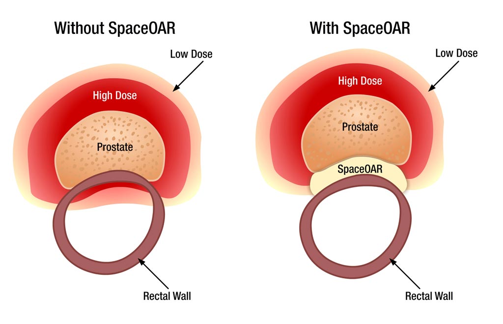 Image: The SpaceOAR system protects surrounding tissues during prostate RT (Photo courtesy of Augmenix).