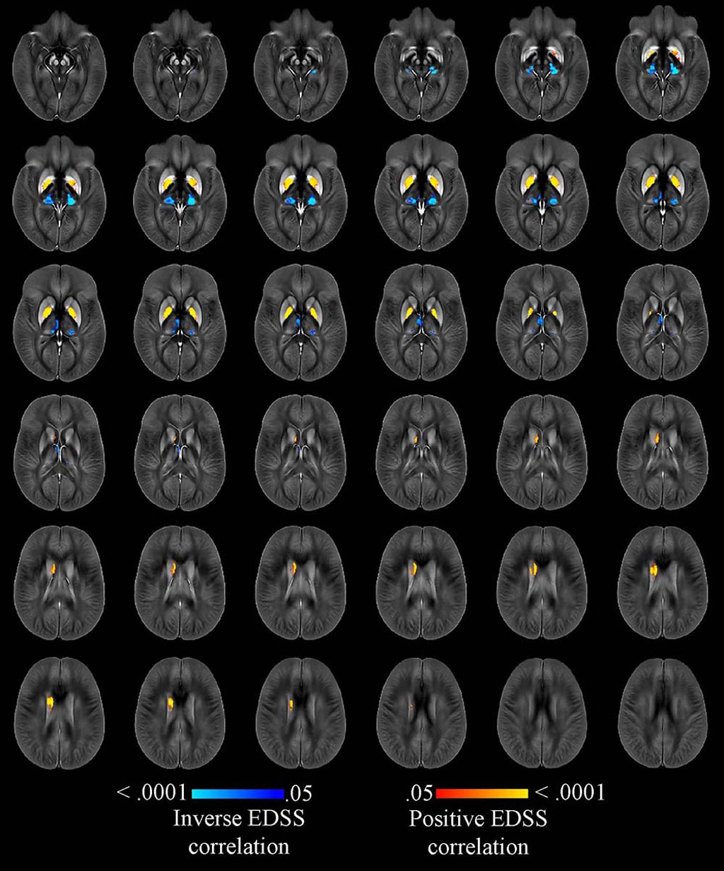 Image: A highly accurate MRI technique can monitor iron levels in the brains of MS patients (Photo courtesy of RSNA).