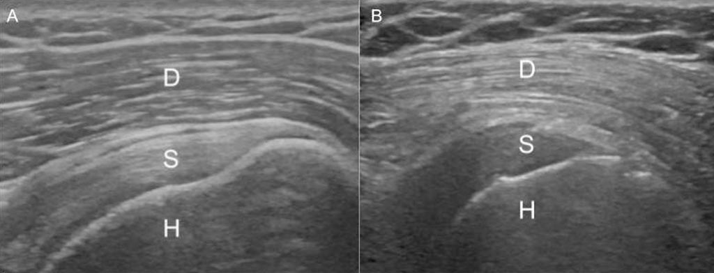 Image: A displays the normal gradient of the deltoid muscle; B shows reversal in T2D patient. D: Deltoid, S: Supraspinatus, H: Humerus (Photo courtesy of RSNA).