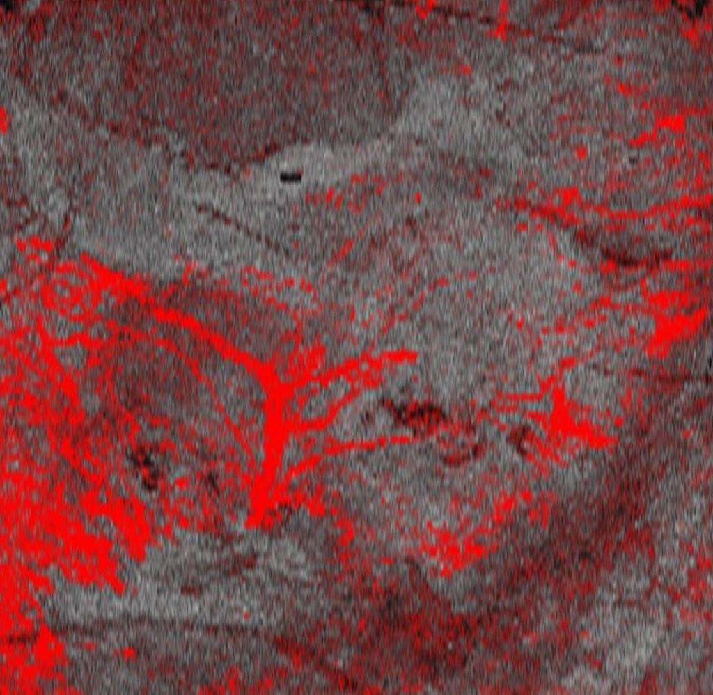 Image: Dynamic OCT image of advanced melanoma taken with the VivoSight scanner (Photo courtesy of Michelson Diagnostics).