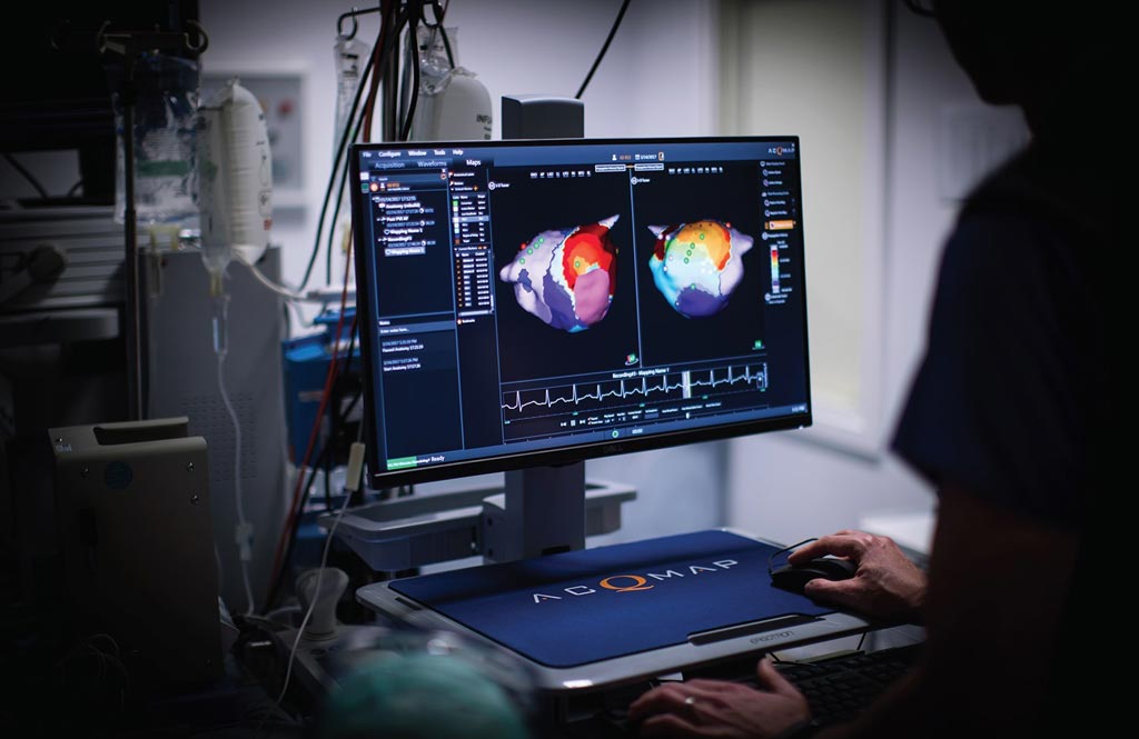 Image: AcQMap creates a full-chamber, 360-degree model of atrium (Photo courtesy of Acutus Medical).