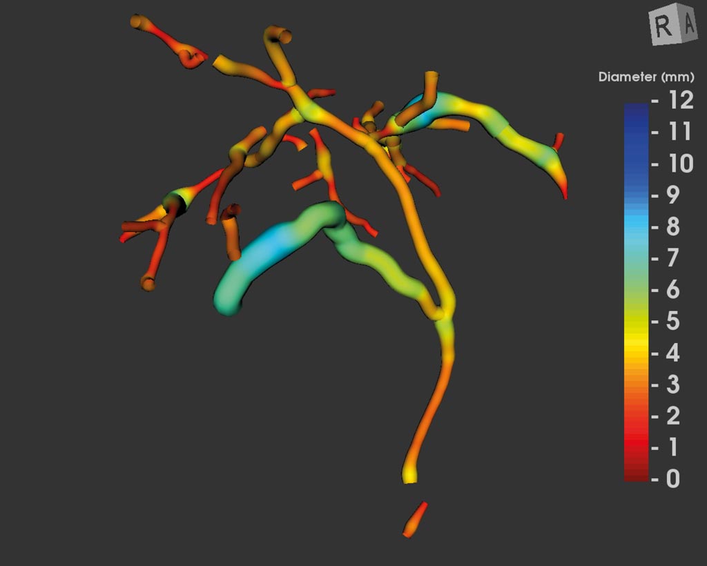 Image: MRCP+ imaging of the biliary tree (Photo courtesy of Perspectum Diagnostics).