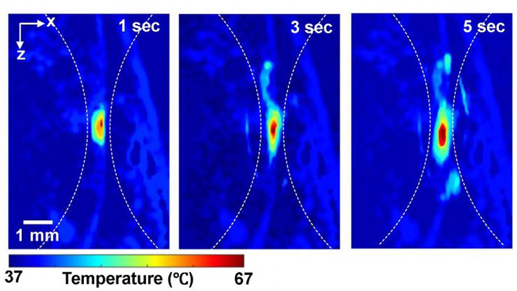 Image: Photoacoustic imaging shows absolute temperatures following high-intensity focused ultrasound (Photo courtesy of Duke University).