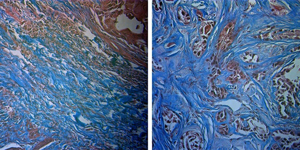 Image: Radiation-sensitive tumor (L), and radiation-resistant tumor (R). Sensitive tumors have more collagen (blue) (Photo courtesy of University of Arkansas).