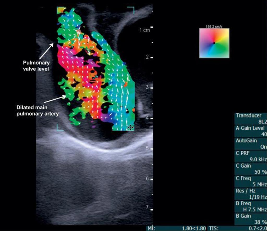 Image: Vector flow imaging demonstrates swirling blood flow (Photo courtesy of Morten Jensen/ UARK).