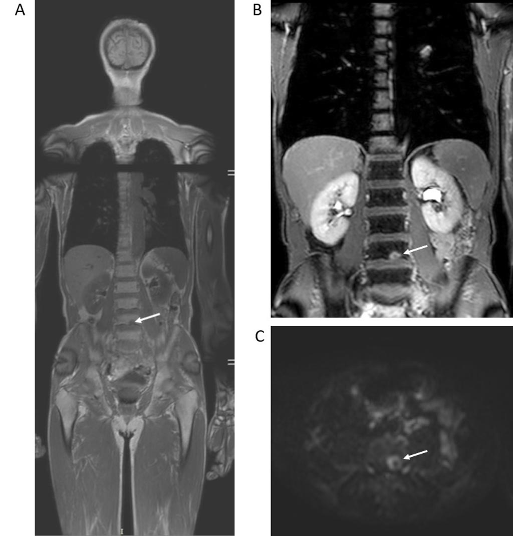 Image: Whole-body MRI reveals a solitary L4 bone metastasis (Photo courtesy of Stuart Taylor/ UCL).