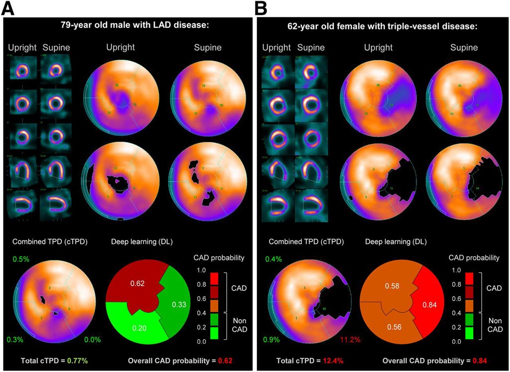 Image: A prediction of obstructive CAD from upright and supine stress MPI. Short/long axis views, polar maps depicting normalized radiotracer count distribution and perfusion defects (top), and predictions by cTPD and DL (bottom) are shown for two patients with obstructive CAD (Photo courtesy of SNMMI).