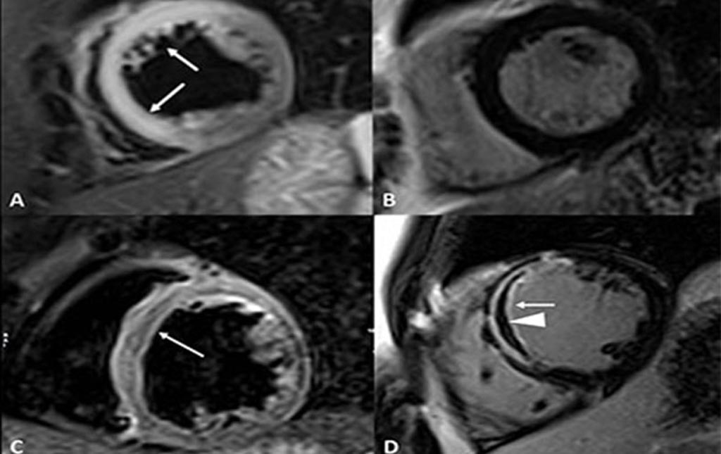 Image: An MRI of a MI in a 44-year-old woman with chronic cocaine abuse (Photo courtesy of Marco Francone/ Sapienza University).