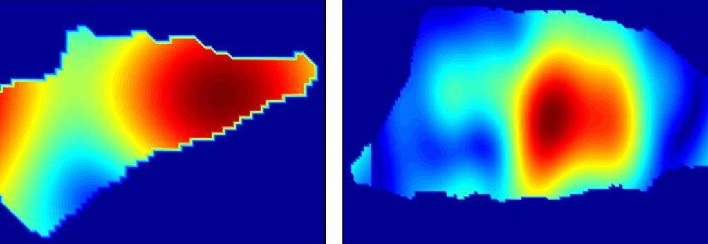 Image: Reflectivity patterns can distinguish between basal cell carcinoma (L) and squamous cell carcinoma (R) (Photo courtesy of Stevens Institute of Technology).